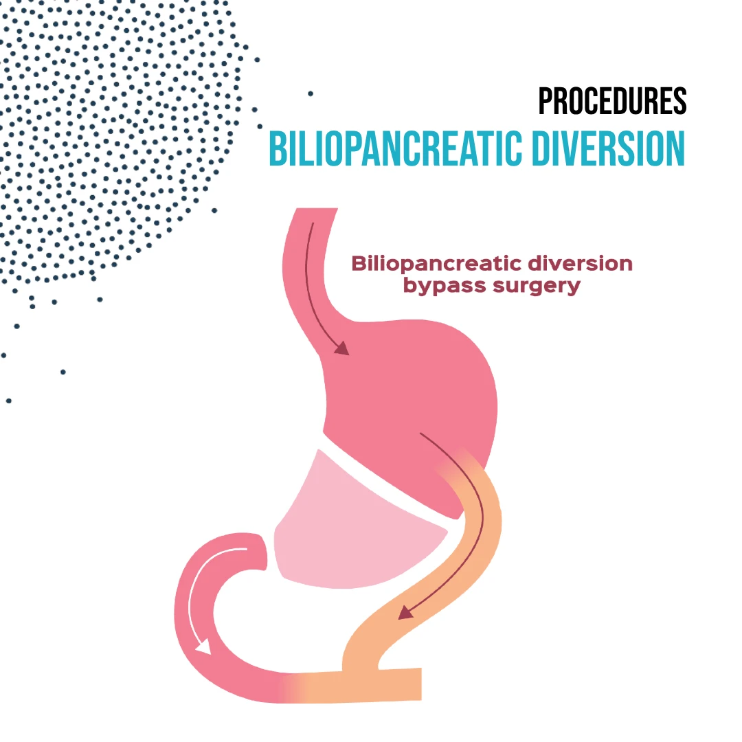 Procedures: Biliopancreatic diversion | Dr. Luis A. Betances, Bariatric Surgeon, Santo Domingo