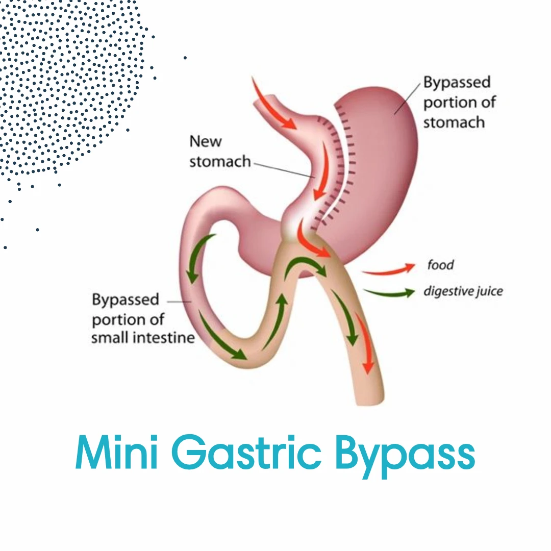 Procedures: Mini Gastric Bypass | Dr. Luis A. Betances, Bariatric Surgeon, Santo Domingo