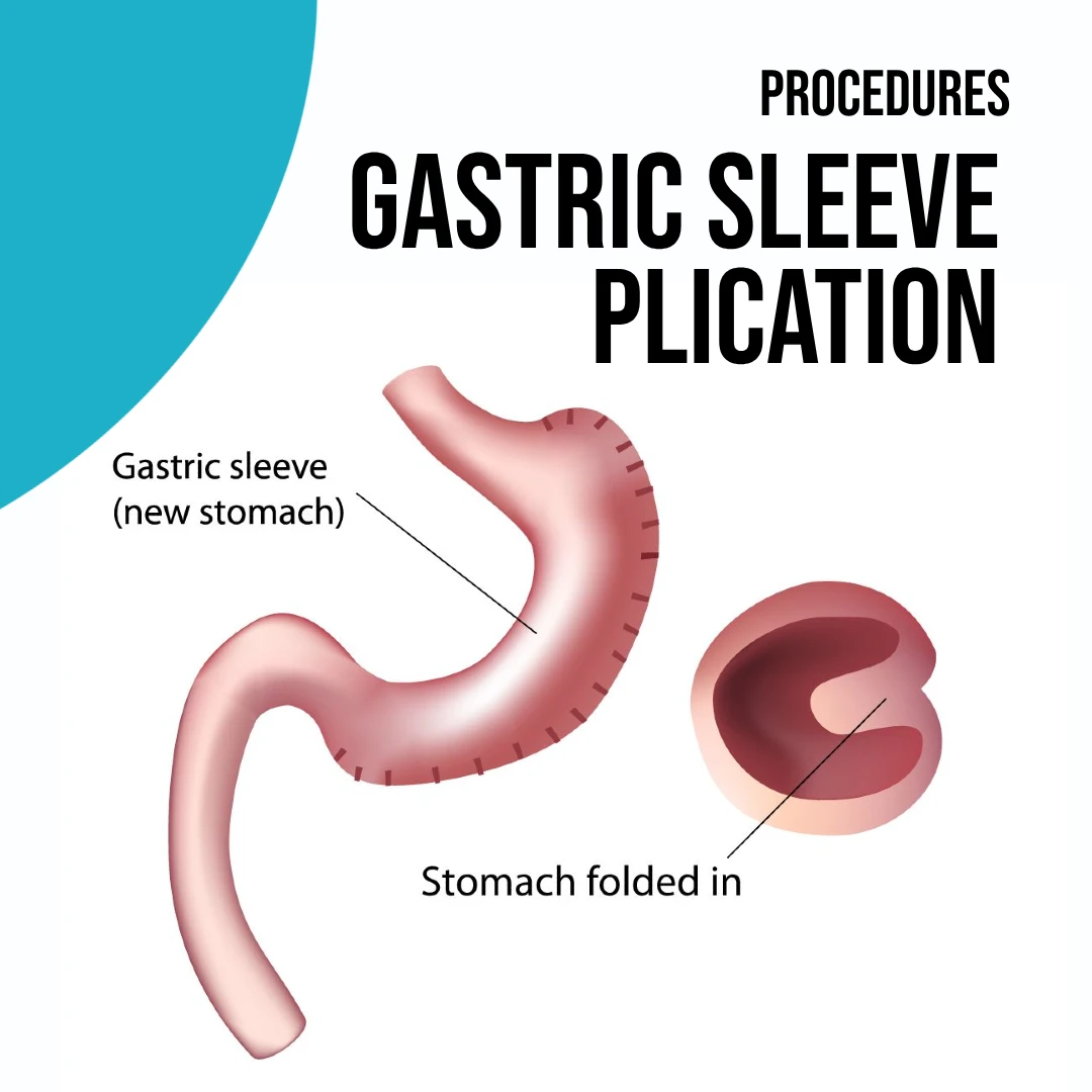 Procedures: Gastric Sleeve Plication | Dr. Luis A. Betances, Bariatric Surgeon, Santo Domingo