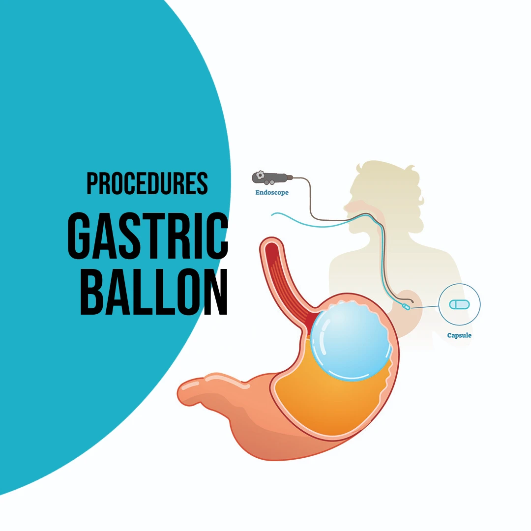 Procedures: Intragastric Ballon | Dr. Luis A. Betances, Bariatric Surgeon, Santo Domingo, Dominican Republic