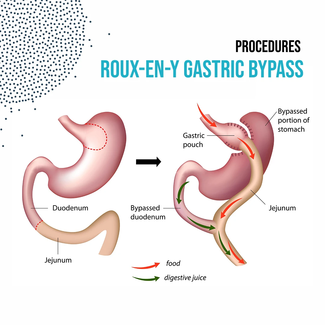 Procedures: Roux-en-Y gastric bypass | Dr. Luis A. Betances, Bariatric Surgeon, Santo Domingo