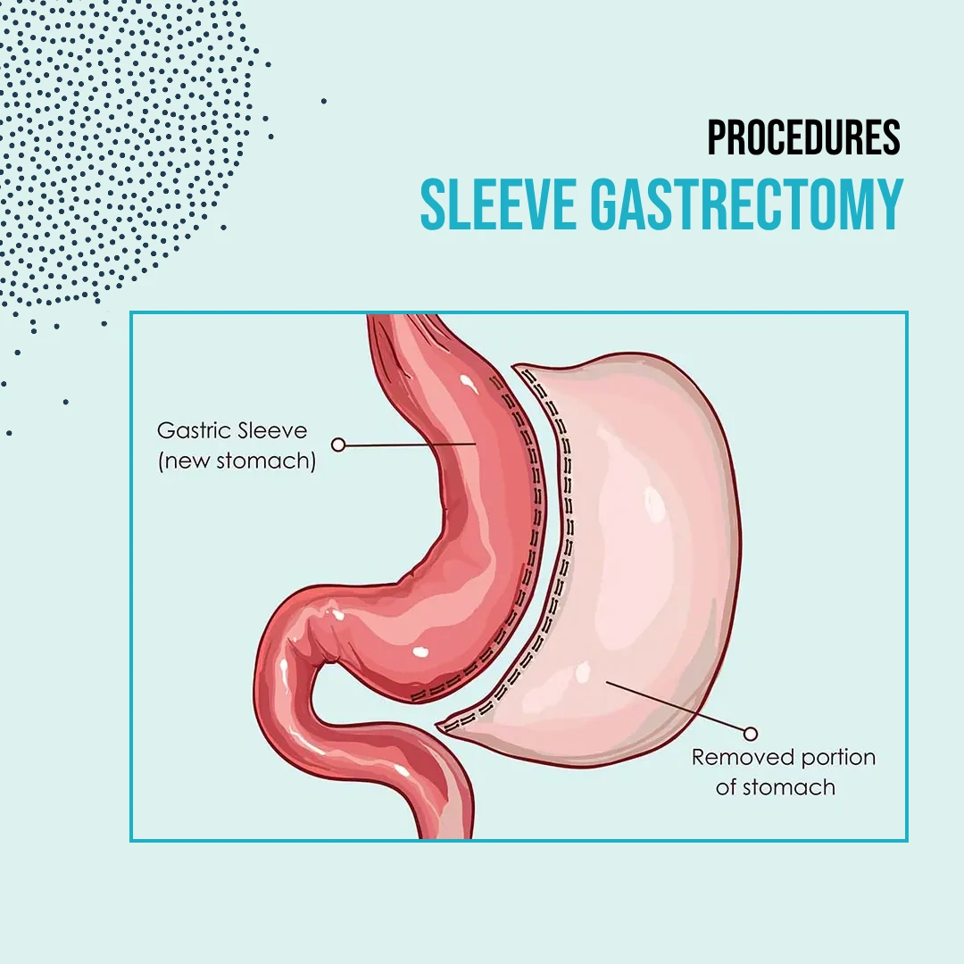 Procedures: Sleeve gastrectomy, | Dr. Luis A. Betances, Bariatric Surgeon, Santo Domingo